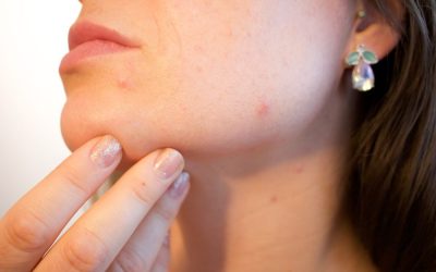 ACNE – AN ALL TOO OBVIOUS PROBLEM