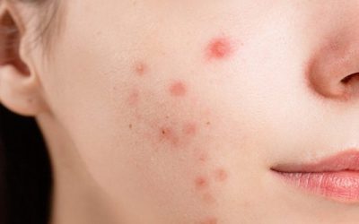 Acne: An All-Too-Obvious Problem