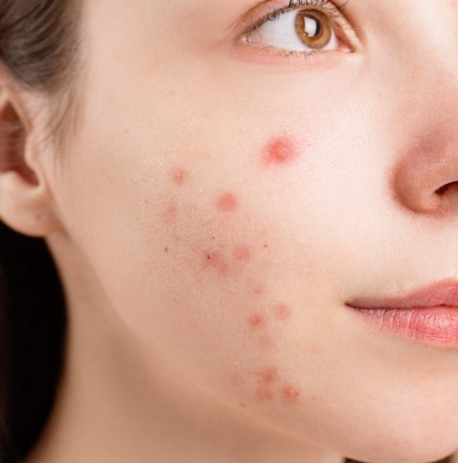 Acne: An All-Too-Obvious Problem