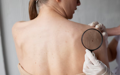 IMPORTANT: The A, B, C, Ds of Skin Cancer