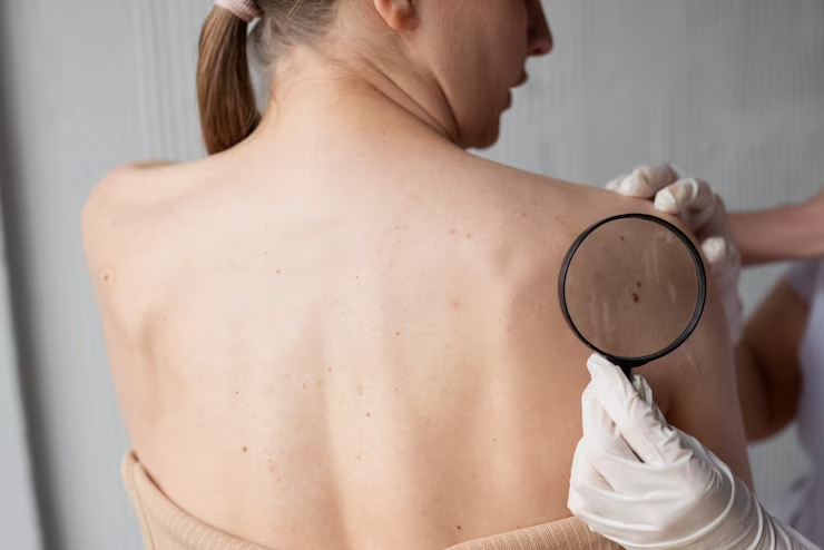 IMPORTANT: The A, B, C, Ds of Skin Cancer